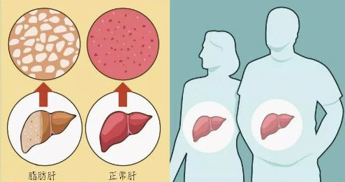 降脂肪肝的食物有哪些——石家庄白求恩医学院